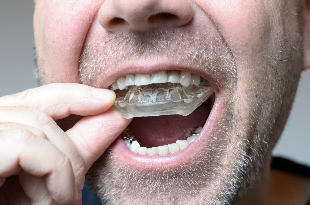 "Man placing a bite plate on his mouth to avoid teeth grinding