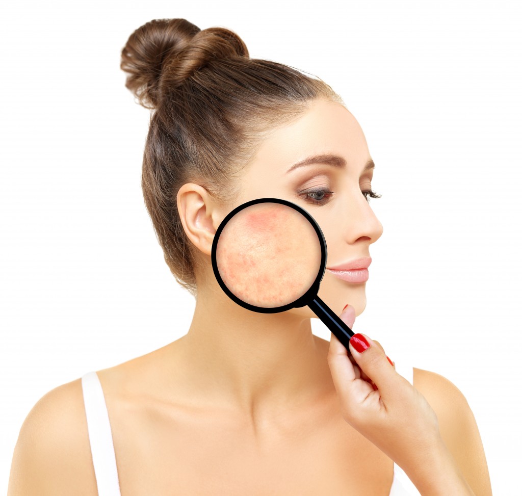 What You Need to Know About Rosacea