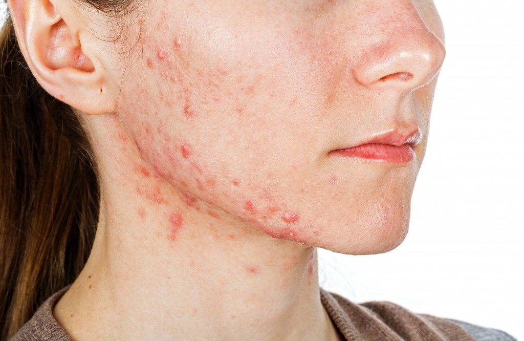 Woman with rosacea on her jaw