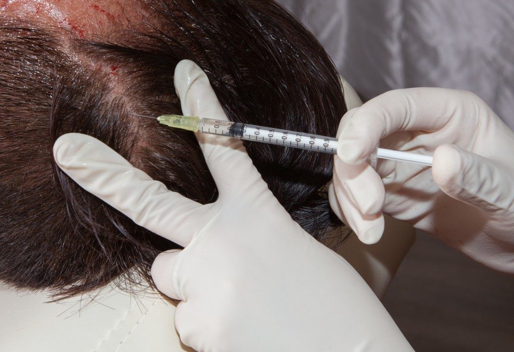 medical treatment of hair loss