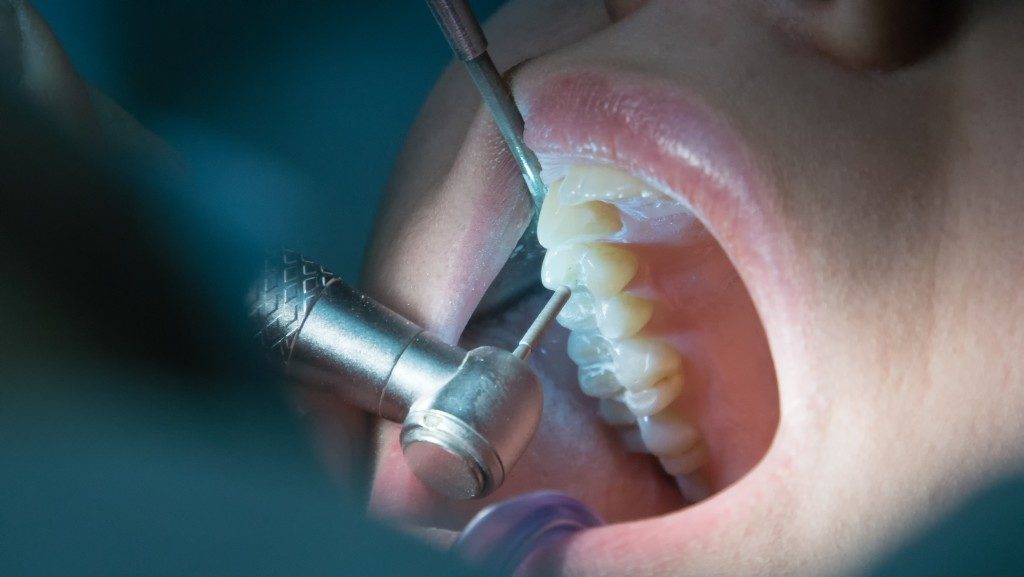 root canal surgery