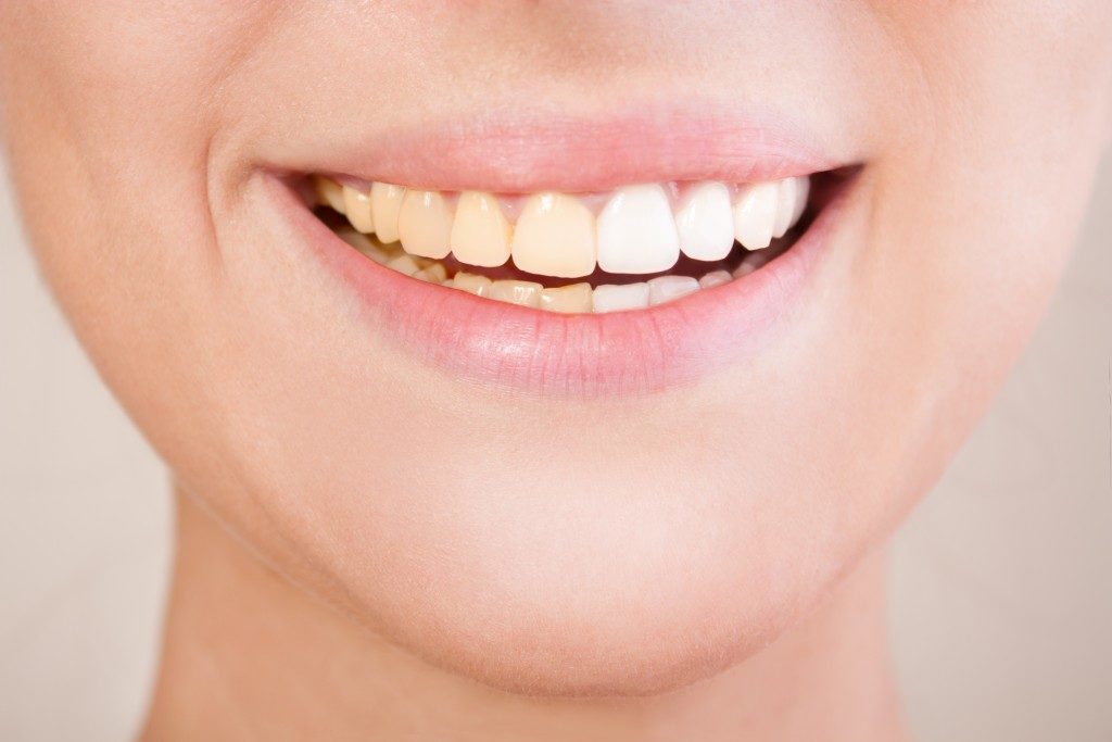 yellowish teeth of a woman