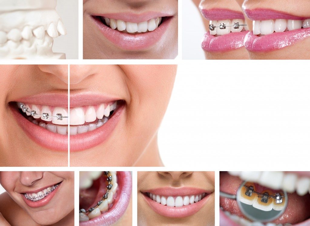 Braces or Invisalign? Most folks who want to straighten their teeth are left with this question. It may seem trivial to some, but to the one who wants a better set of teeth, it’s a tough decision to make. Given the resources available online, it's still best to consult an orthodontist to make an informed decision. Invisalign is not always the ideal option for people, which is why you need an orthodontist’s opinion. On the other hand, some people are uncomfortable with the thought of having metals attached to their teeth, although now there are several options for braces including lingual and ceramic braces. West Jordan, UT has some of the best orthodontists that can help shed some light on the matter. While you’re still planning your visit to the nearest orthodontist, why don’t you take a look first at our comparison between the advantages of both braces and Invisalign: The Advantages of Braces It is great for all types of treatments. Invisalign is not always the best treatment method. Braces, on the other hand, can be used to deal with any dental issue. As it uses metal wire and anchors to pull your teeth into its proper alignment, it is the most effective method of moving and correcting your teeth’s position. Perfect results are achievable. Braces are designed to move teeth in position better since it has more force due to the metal wire and anchors. Invisalign is quite limited in the number of teeth it can move at a single time. There are several types to choose from. If having a metallic mouth turns you off, there are plenty of other different braces to choose from, including clear, ceramic, and lingual (behind the teeth) braces. Treatment time is faster. When it comes to closing gaps between the teeth and aligning them, braces have the upper hand over Invisalign. Orthodontists schedule appointments to check on your teeth’s progress and make the necessary adjustments based on the developments. Normally, people would want their orthodontic treatments to be done within the quickest possible time. Your orthodontist’s experience and skill level can further speed up the treatment time. The Advantages of Invisalign It looks better. Most adults and self-conscious teens would prefer having invisible orthodontic treatment because it doesn’t look awkward on them. You won’t even have to worry about having a shiny metallic smile in photographs. It is easier to eat and clean teeth. Having Invisalign means you get to eat and clean your teeth as you normally would without it. As the recommended hours to wear Invisalign is only 20 to 22 hours a day, you can take them off whenever you eat or brush and floss your teeth. It is a lot easier compared to having braces. Consultations aren’t as frequent. A huge chunk of the orthodontist’s work takes place before you wear retainers. Your teeth are scanned in 3D and the results are forwarded to a laboratory where they make your custom retainers. Trips to the clinic are kept to a minimum because no regular adjustments are needed. This means you won’t waste filing leaves from work just to visit your orthodontist. They are comfortable. It is often advertised as less painful compared to braces. The retainers are made from special plastic and are cast and created to fit a specific patient’s mouth. This means you don’t get as much gum and mouth problems with Invisalign. You need to consider a lot of things in choosing which one is the right orthodontic treatment that’s suitable for you. Take a closer look at your options and ask experts for their opinions. Gathering as much information as you can help you make the right decision.