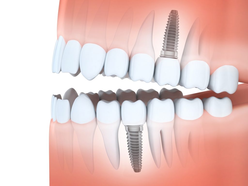 dental implants concept