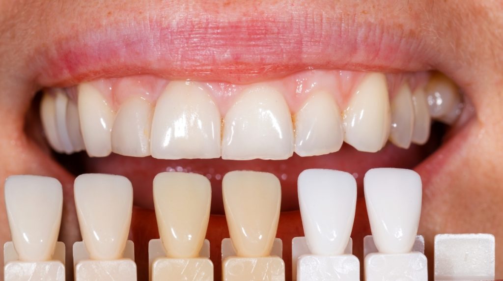 teeth color selection