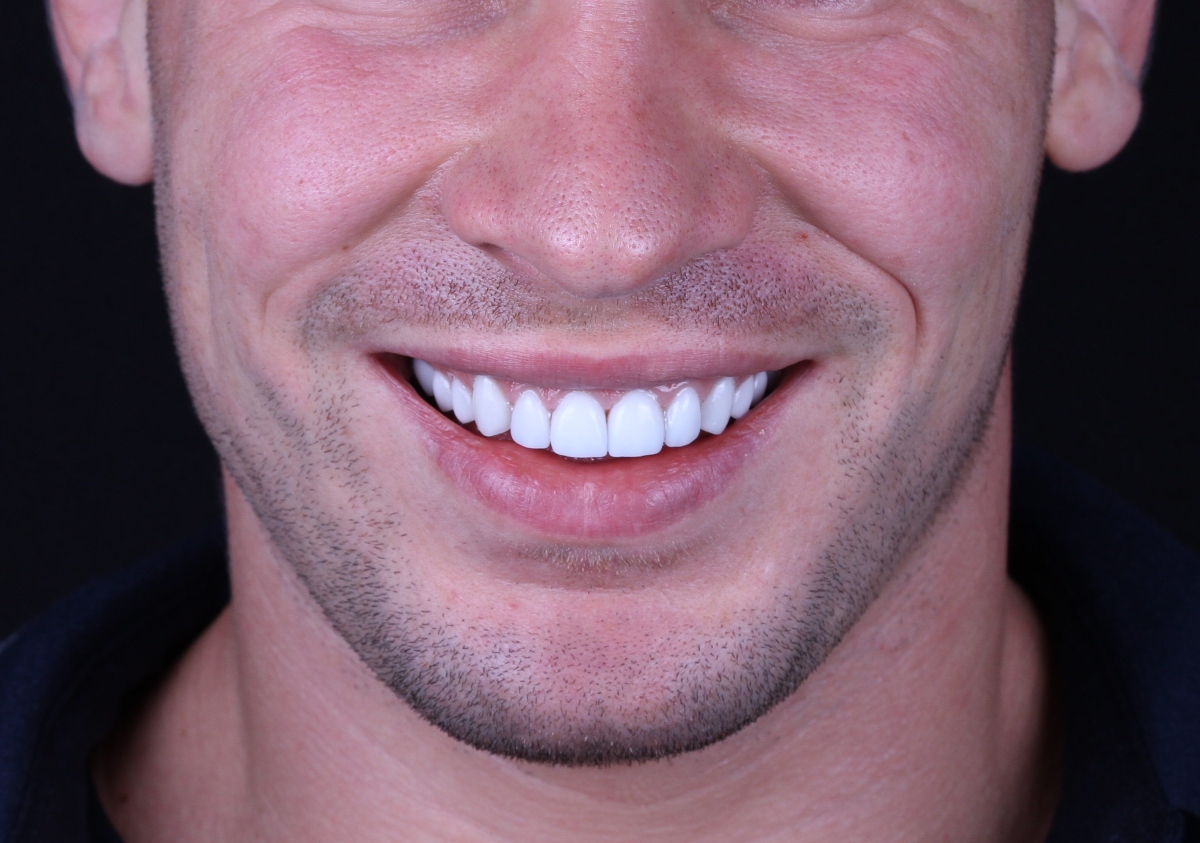 Veneers: creating a flawless smile!