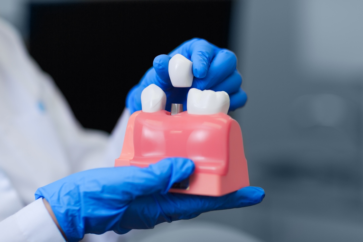 doctor holding model of dental implants