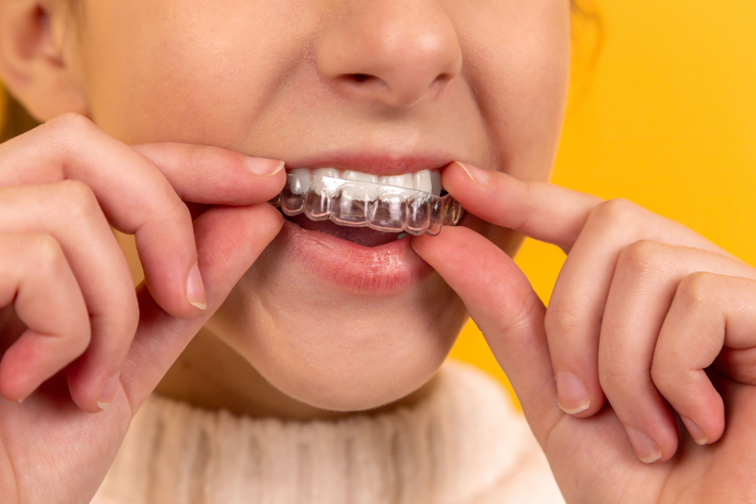 Feeling crooked? Let Invisalign get you realigned